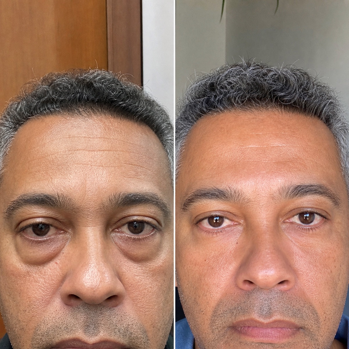 Resultado visual do cuidado para o contorno dos olhos
