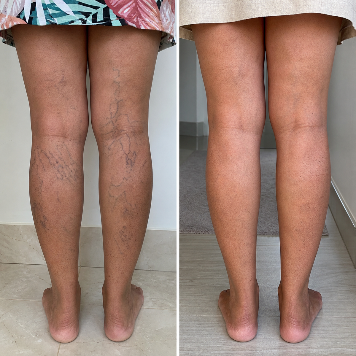 Pernas femininas com veias aparentes acompanhadas durante o tratamento